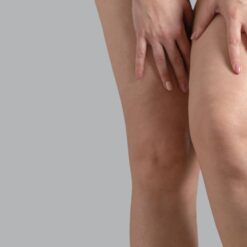 Alternative view of PROTOCOLLO CELLULITE